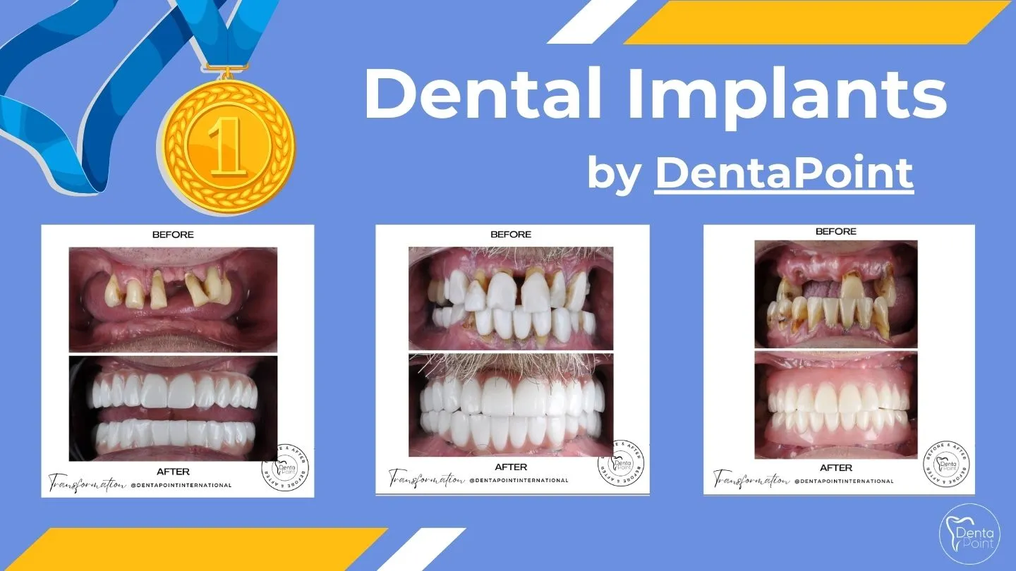 Dental Implants Before and After in Turkey